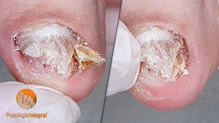 Podological procedure to alleviate the feet and restore comfort wearing closed shoes