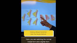 Meme Rekonstrüksiyonu Tüberöz Memenin Basit Metodla Düzeltilmesi Dr. Erdem Güven