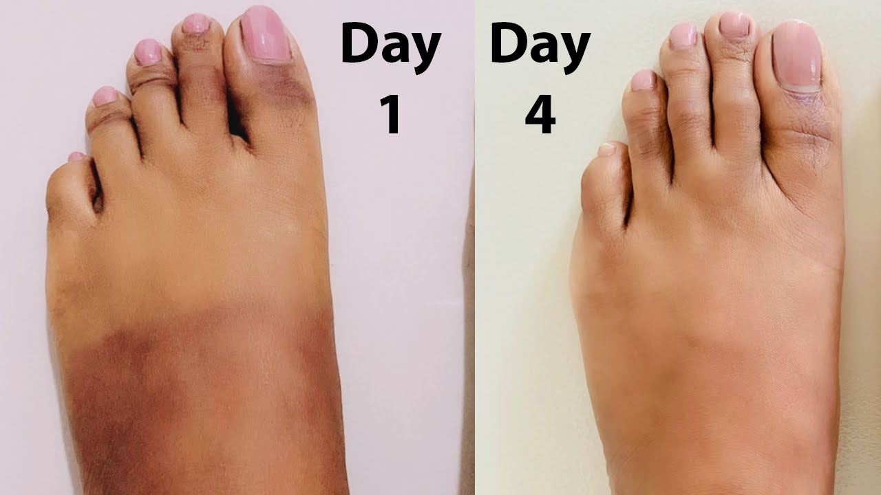 4 Day Foot SUNTAN, SUNBURN Removing Method With RESULTS YouTube