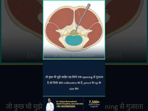 'Monoportal' का मतलब क्या होता है? — Hyderabad के Best Monoportal Endoscopic Spine Surgeon