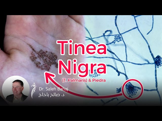 12. Tinea nigra (Palmaris) & Piedra 