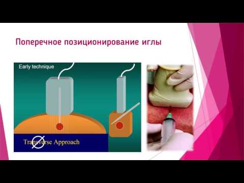 Применение ультразвуковой шкалы BI-RADS в интервенционной маммологии.