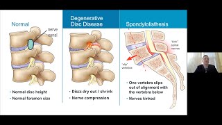 Spine Surgery: Minimally Invasive & Complex, by Bryan Krueger, MD