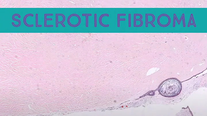 Sclerotic fibroma (storiform collagenoma/plywood fibroma) pathology dermatology dermatopathology