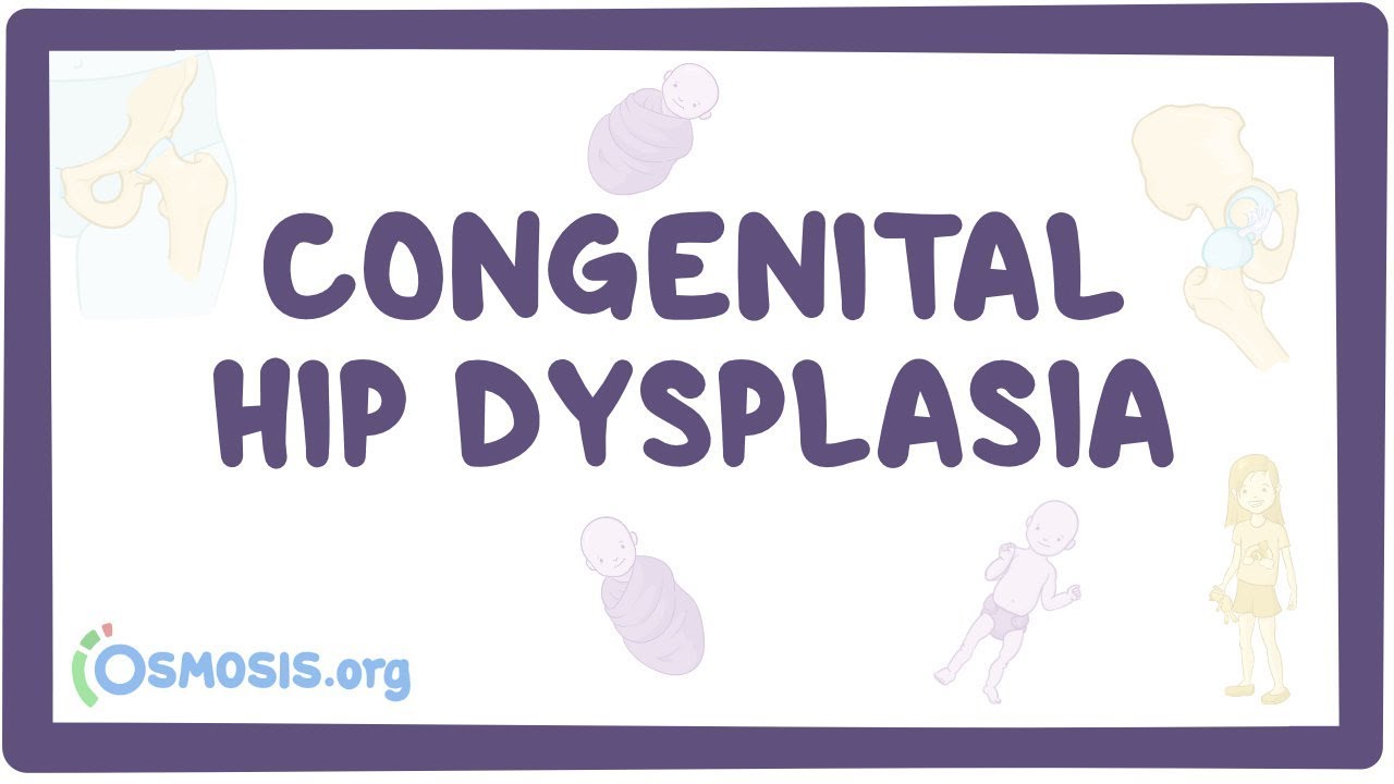 congenital hip dysplasia
