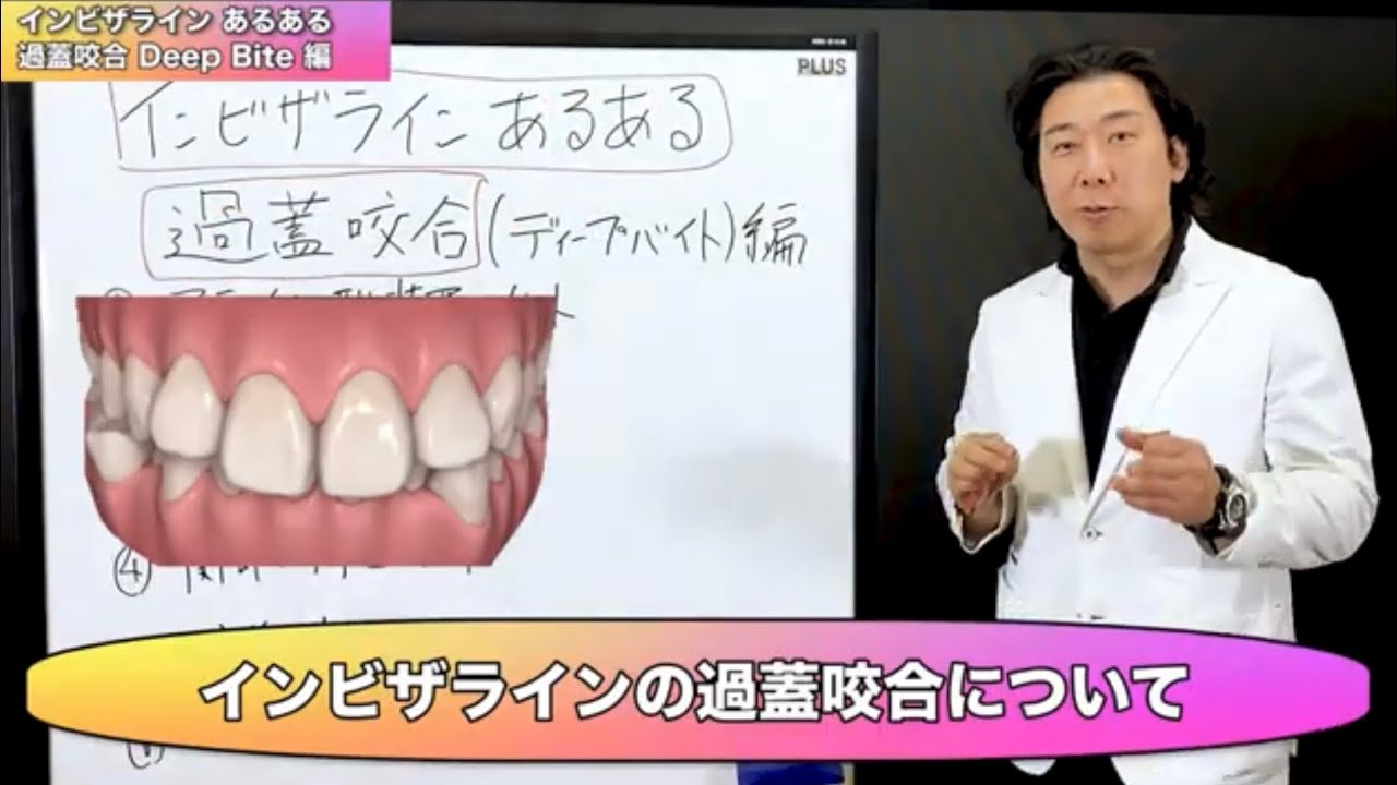 [インビザラインあるある]過蓋咬合治療の考え方