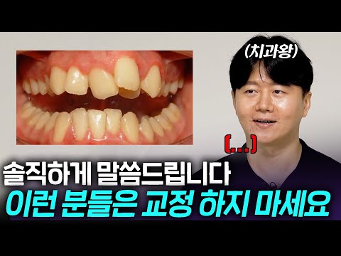 치과의사도 놀란 치아 교정 성공 사례 TOP4 이게 된다고 