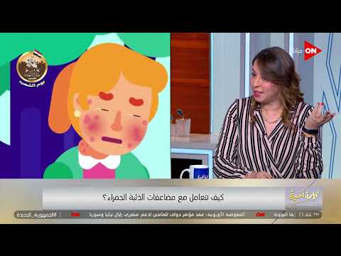 كلمة أخيرة هل مرض الذئبة الحمراء معدي