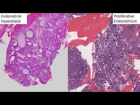 GYN Pathology Basics: Endometrial Hyperplasia to Endometrioid Adenocarcinoma