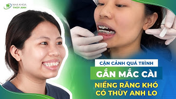 GẮN MẮC CÀI NIỀNG RĂNG HÔ - LỘ TRÌNH VÀ CHI PHÍ NIỀNG RĂNG CHI TIẾT
