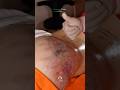Lipofilling amaliyoti. Dr. Nilufar Raxmatovna +998-90-027-77-76