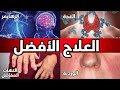 العلاج الأول لجميع أمراض المناعة الذاتية 