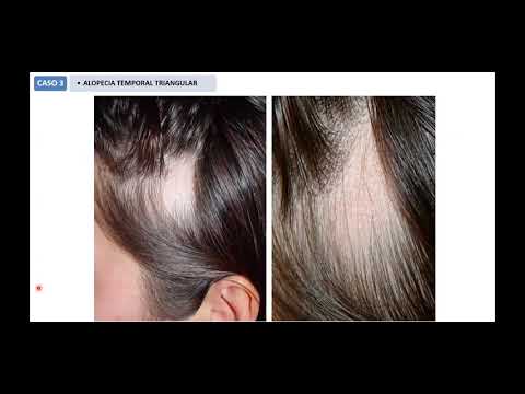 Segunda parte Como no enredarse en la interpretación de una biopsia de piel por alopecia