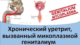 Хронический уретрит, вызванный микоплазмой гениталиум