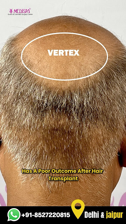 Why Crown (Vertex) Hair Transplants Have Lower Success Rates | Explained by Dr. Suneet Soni