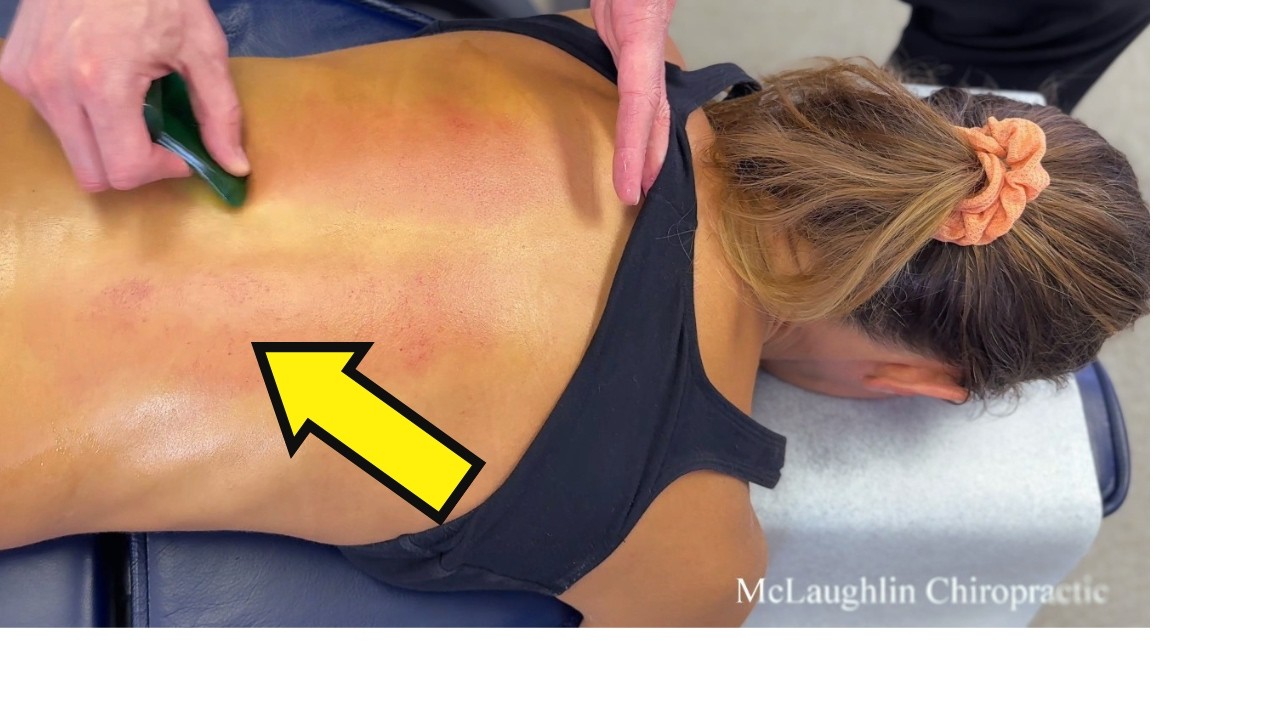 Understanding Spondylosis: Deep Extension Injuries and Spinal Alignment