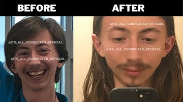 I Did Thumbpulling for a Year and THIS is why I stopped | Mewing Transformation