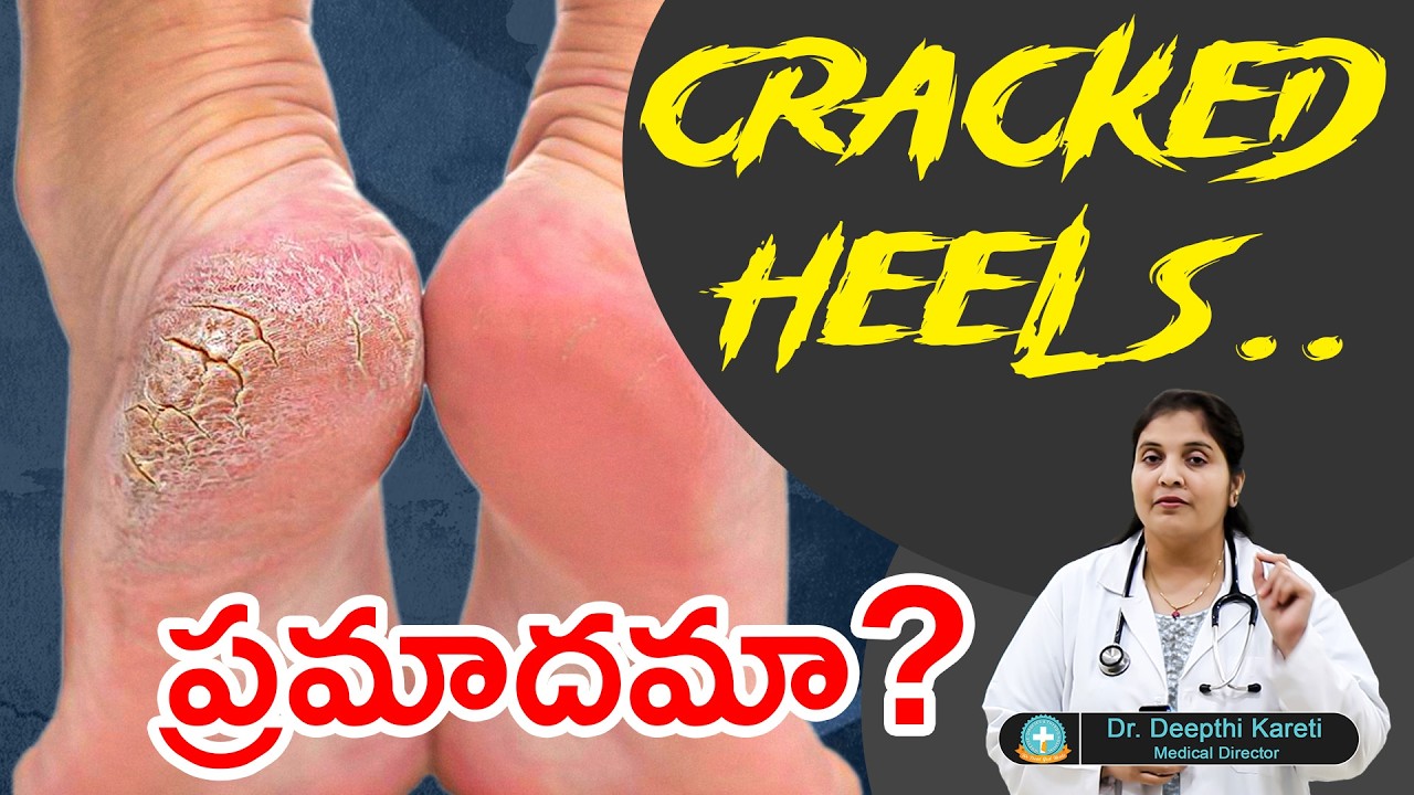 అరికాళ్ళ పగుళ్లు ఎందుకు వస్తాయి| Doctor Deepthi Kareti explains| Immense Diabetes Hospital