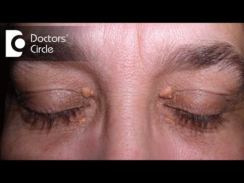 How to get rid of skin tags from upper eyelids or eye region?-Dr. Nischal K