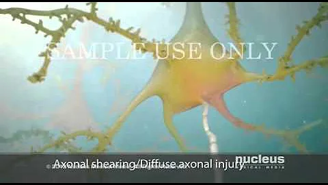 Axonal shearing