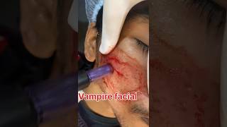 &quot;Let your skin sparkle like a diamond with Vampire lift&quot; #vampirefacelift #celebritysurgeon