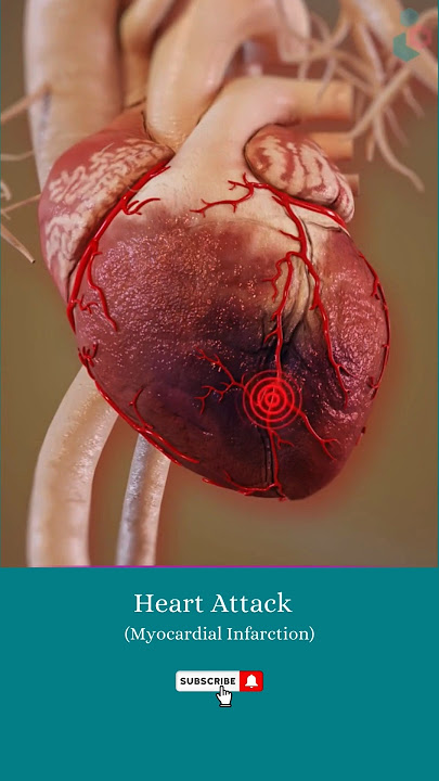 What happens during a heart attack? ↪ 3D Medical Animation #Shorts #HeartAttack #Heart #Health