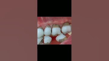 What are the consequences of MISSING teeth?