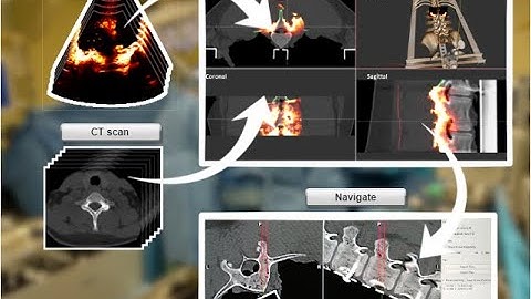 Intraoperative Ultrasound-based Navigation for Spine with IBIS - Demo