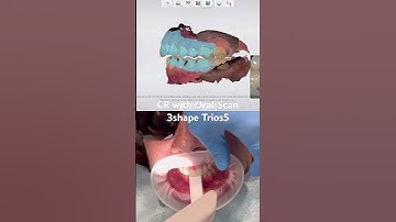 Taking centric relation using leaf gauge with oral scan 3shape trios5