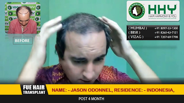 Hair Transplant Result After 4 Months - 4866 FUEs