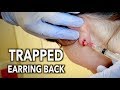 REMOVING A TRAPPED EARRING BACK (from inside the earlobe) | Dr. Paul