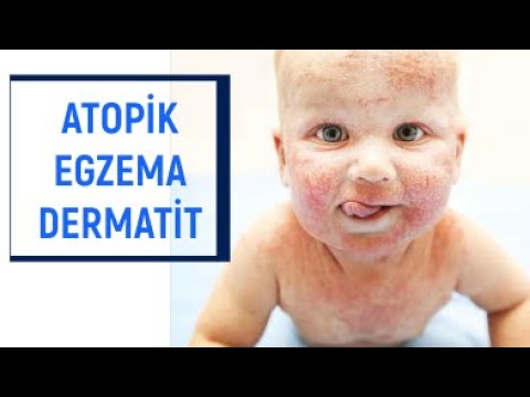 Video: Uşaqlarda və böyüklərdə atopik dermatit üçün pəhriz