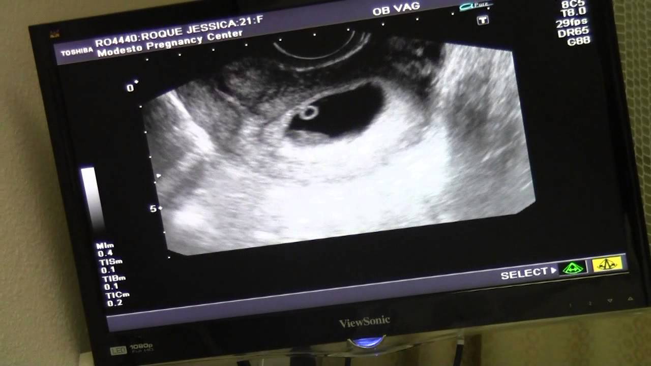 Ultrasound pregnant 8 weeks 8 Weeks