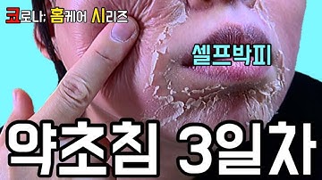 [코로나; 홈케어 시리즈] 셀프박피?약초침 3일차 | 여드름흉터 | 색소침착 | 모공축소 | Covid Homecare | Krauter Peeling | 배유진 YUJIN B