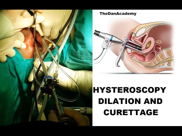 Dilatation and curettage