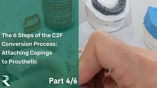 The 6 Steps of a CHROME C2F Conversion: Coping Attachment to Prosthetic