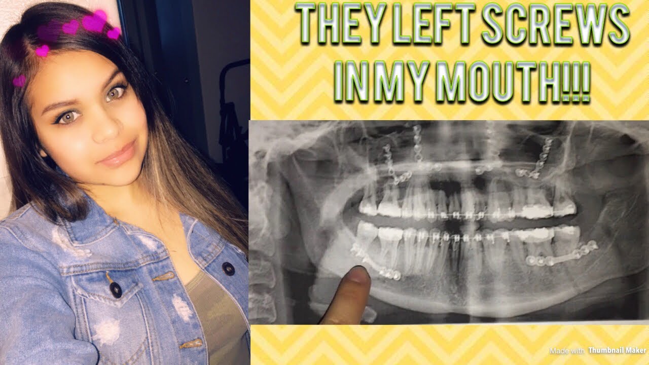 camera iphone 8 plus apk GRWM: UPDATE OF MY DOUBLE JAW SURGERY!