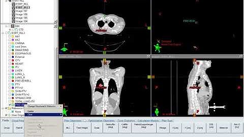 3 Setting the Isocenter for Lung SBRT