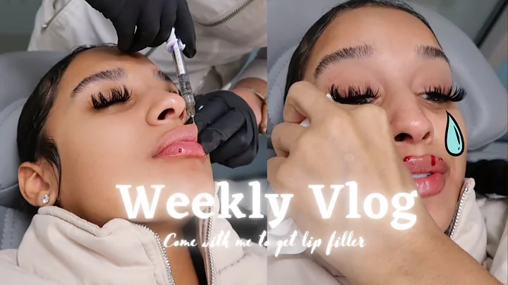 COME GET LIP FILLER WITH ME  | WEEKLY VLOG