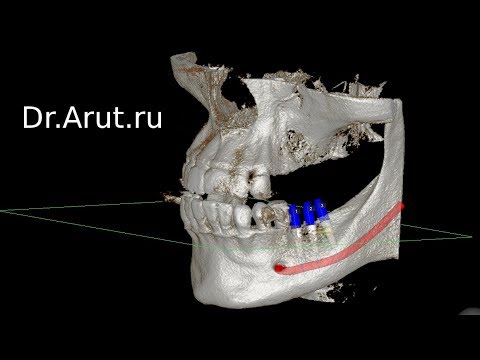 Video: Nová Metóda Segmentácie Tkanív Na Výpočet 3D Dávky Pri Rádioterapii Malých Zvierat