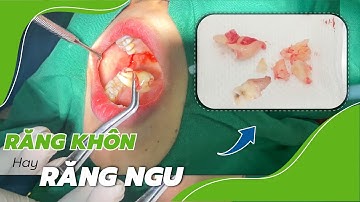 Cận cảnh Nhổ răng khôn có chân răng sát ống dây thần kinh hàm dưới