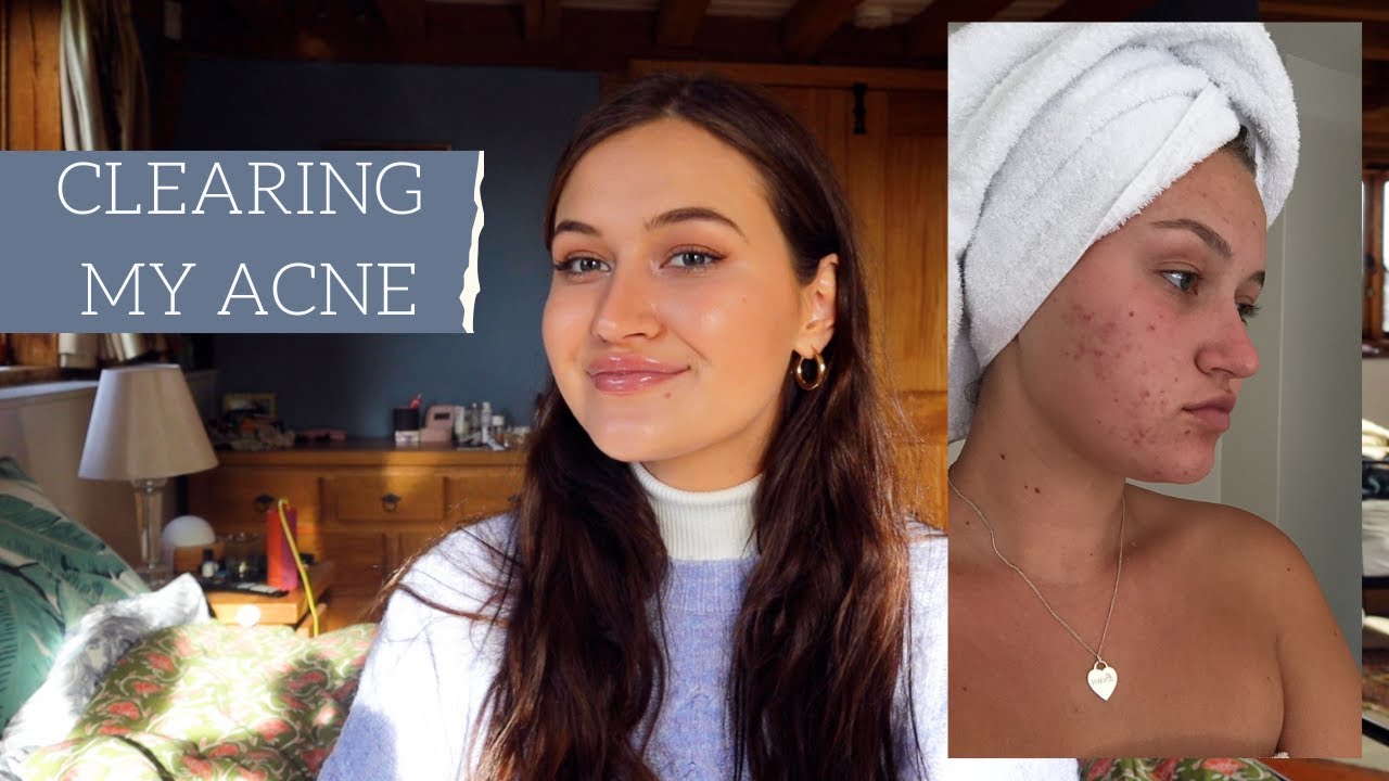 MY SKIN STORY + HOW I CLEARED MY ACNE | SHE TRAVELLED THE WORLD - YouTube