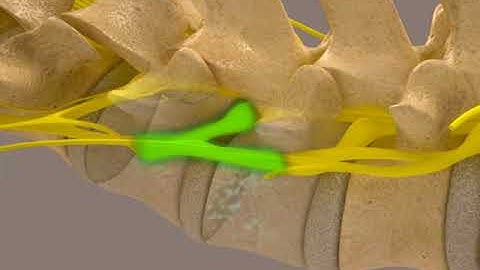 How Spinal Decompression Works with the KDT Systems & Technique