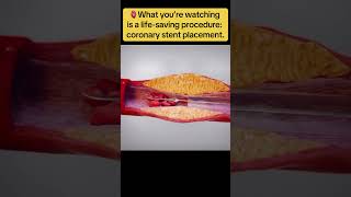 Coronary Stent Placement: Watch a Blocked Artery Get Fixed! 💥🫀