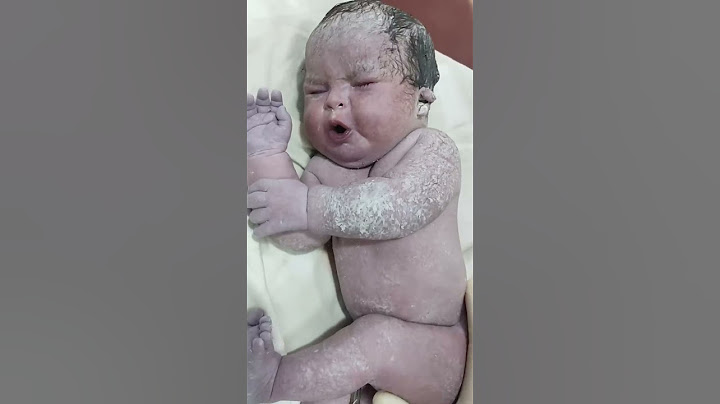 Beautiful Chubby Newborn baby immediately after birth with Down syndrome