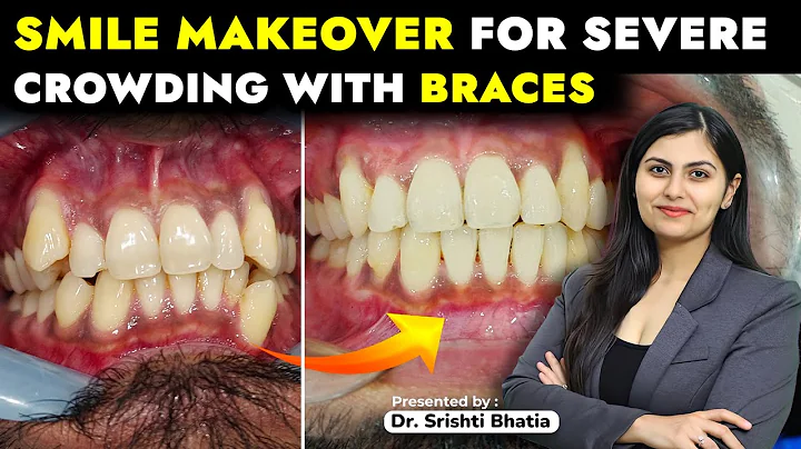 Smile Makeover for Crooked Teeth with Braces: Dr. Srishti Bhatia #braces #smilemakeover #smile