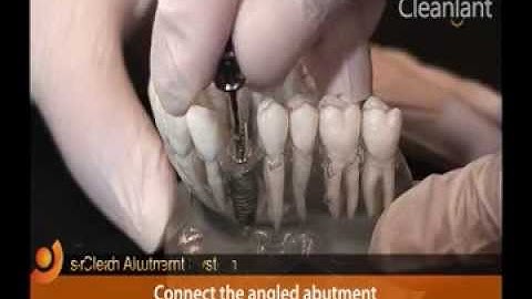 Angled Abutment