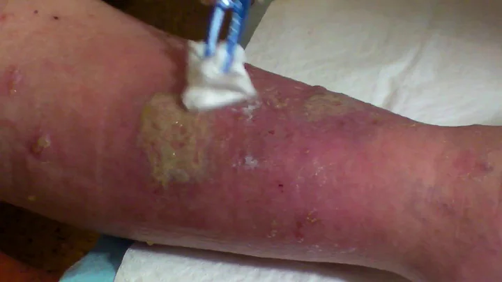 Sloughy, infected wound requiring daily dressings ...