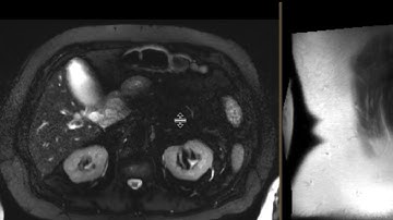 Distal CBD cholangiocarcinoma