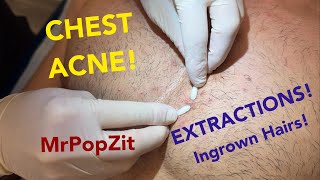 Chest congestion-blackheads, whiteheads, ingrown hairs. Multiple plugs extracted, patient left happy